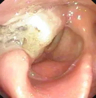 民生纪实嗓子痒异物感持续两个月咽喉部长了一个大枣的原因