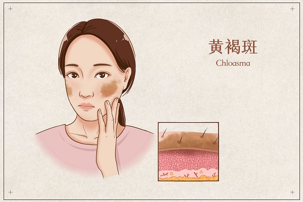 摄图网_401867188_banner_黄褐斑医疗插画（企业商用）.jpg